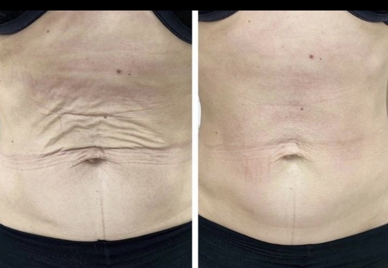 Antes e Depois Tratamento Corporal de Flacidez Abdominal