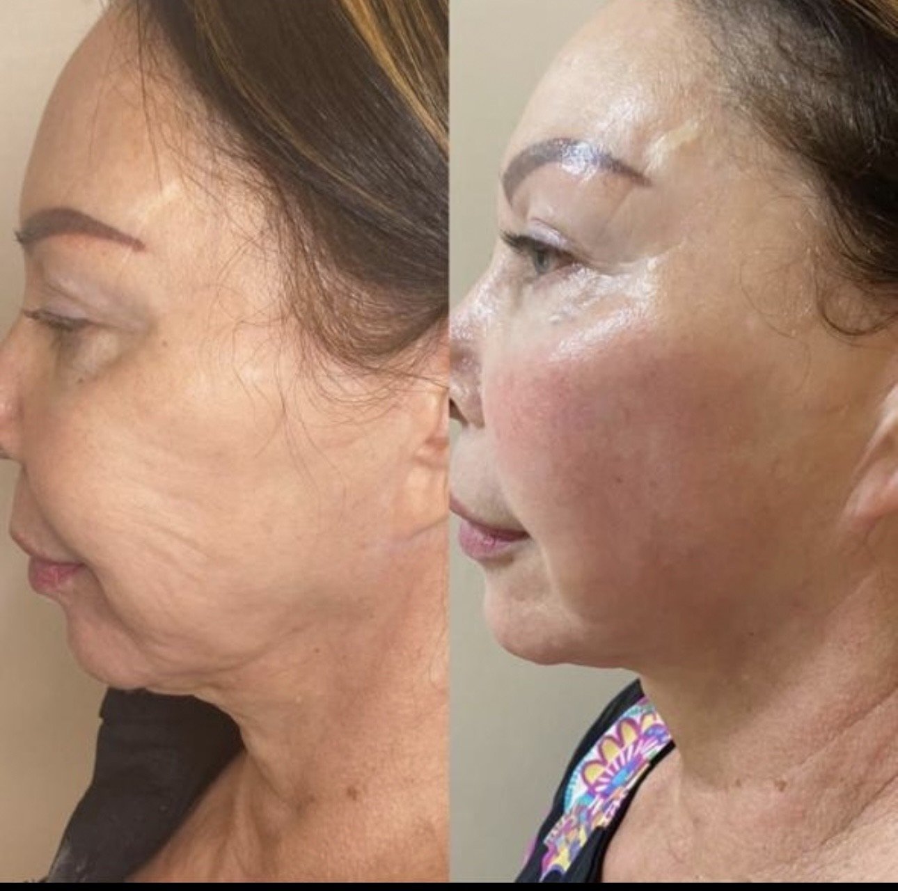 Antes e Depois - Contorno de Pescoço e Papada