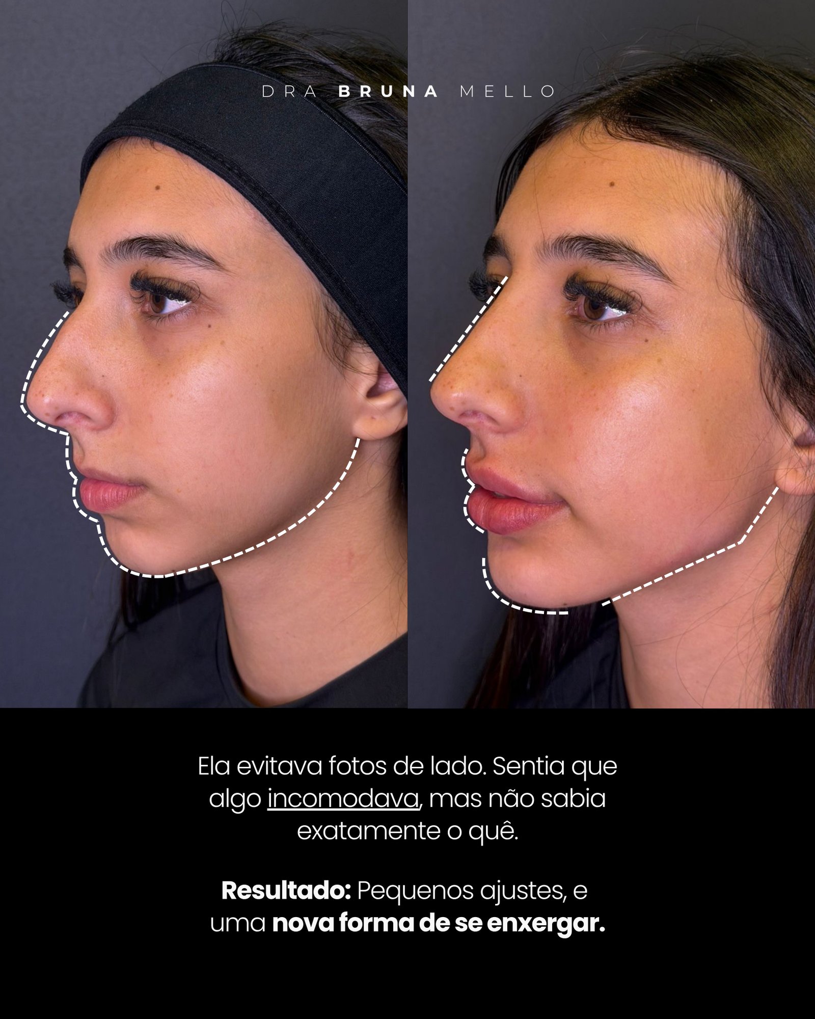 Antes e Depois Harmonização de Perfil Facial