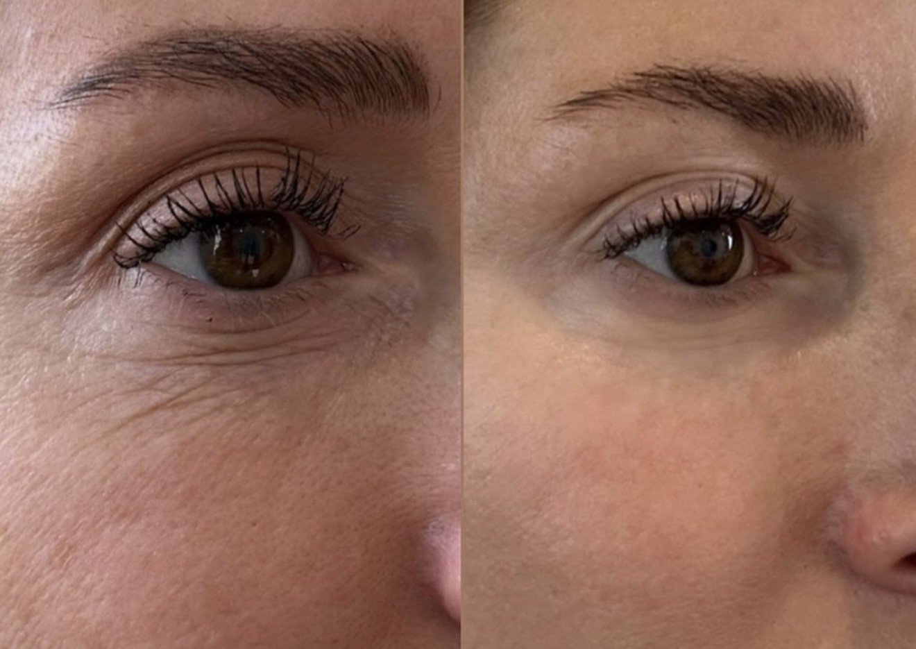 Antes e Depois Rugas Perioculares e Olhar - Dra. Bruna Mello