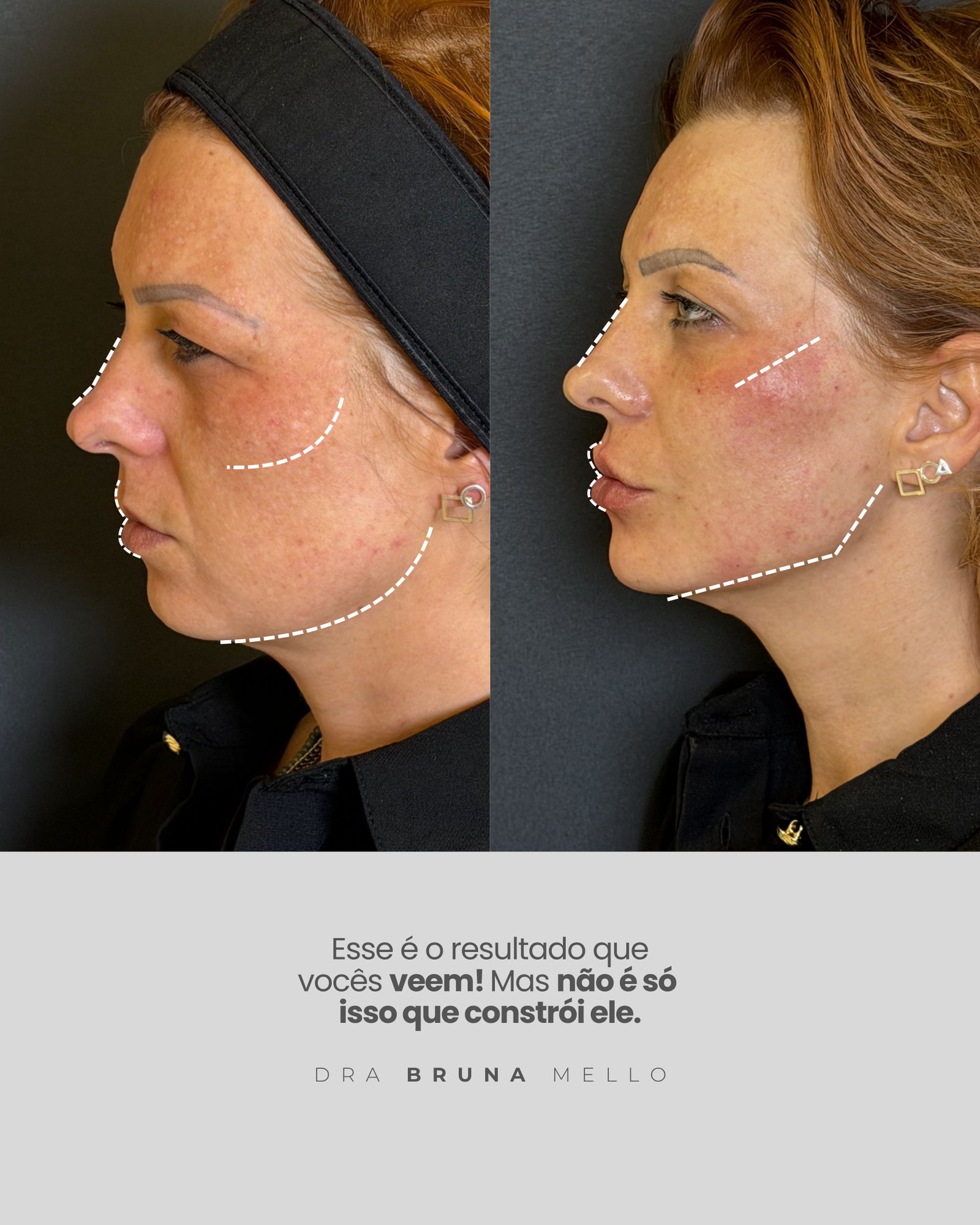 Antes e Depois Face Lift 360 Rejuvenescimento